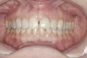 Dental Implants case study