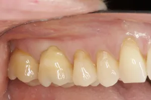 Allograft case study