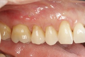 Allograft case study
