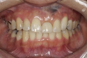 Dental Implants case study