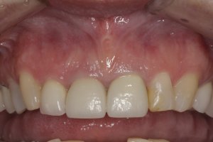 Dental Implants case study