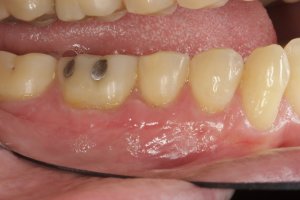 Allograft case study