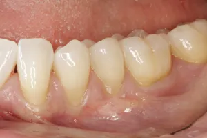 Allograft case study