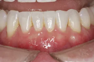 Allograft case study