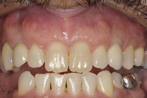 Dental Implants case study