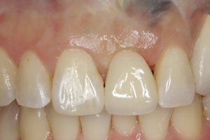 Dental Implants case study