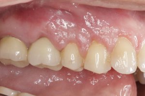 Allograft case study