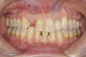 Dental Implants case study