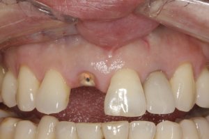 Dental Implants case study