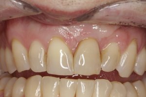 Dental Implants case study