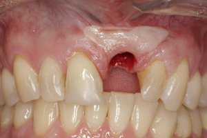 Dental Implants case study