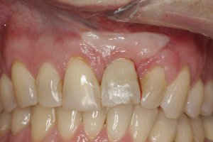 Dental Implants case study