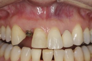 Dental Implants case study