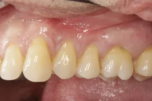 Allograft case study