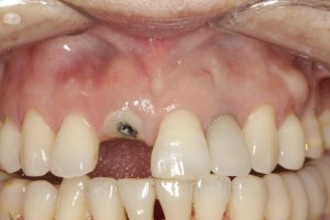 Dental Implants case study