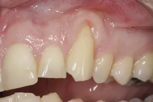 Allograft case study