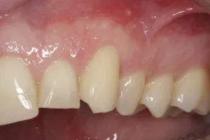 Allograft case study