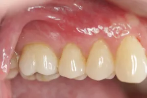 Allograft case study