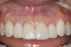 Dental Implants case study