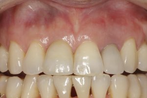 Dental Implants case study
