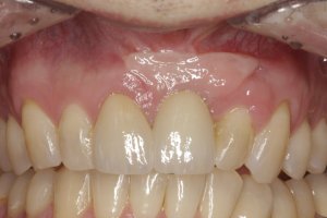 Dental Implants case study