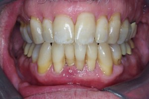 Dental Implants case study